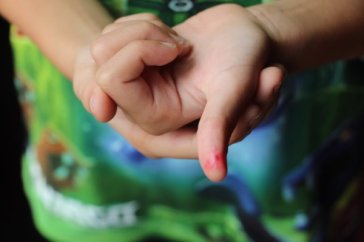 Home Remedies for Cuts, Bruises & Swellings 